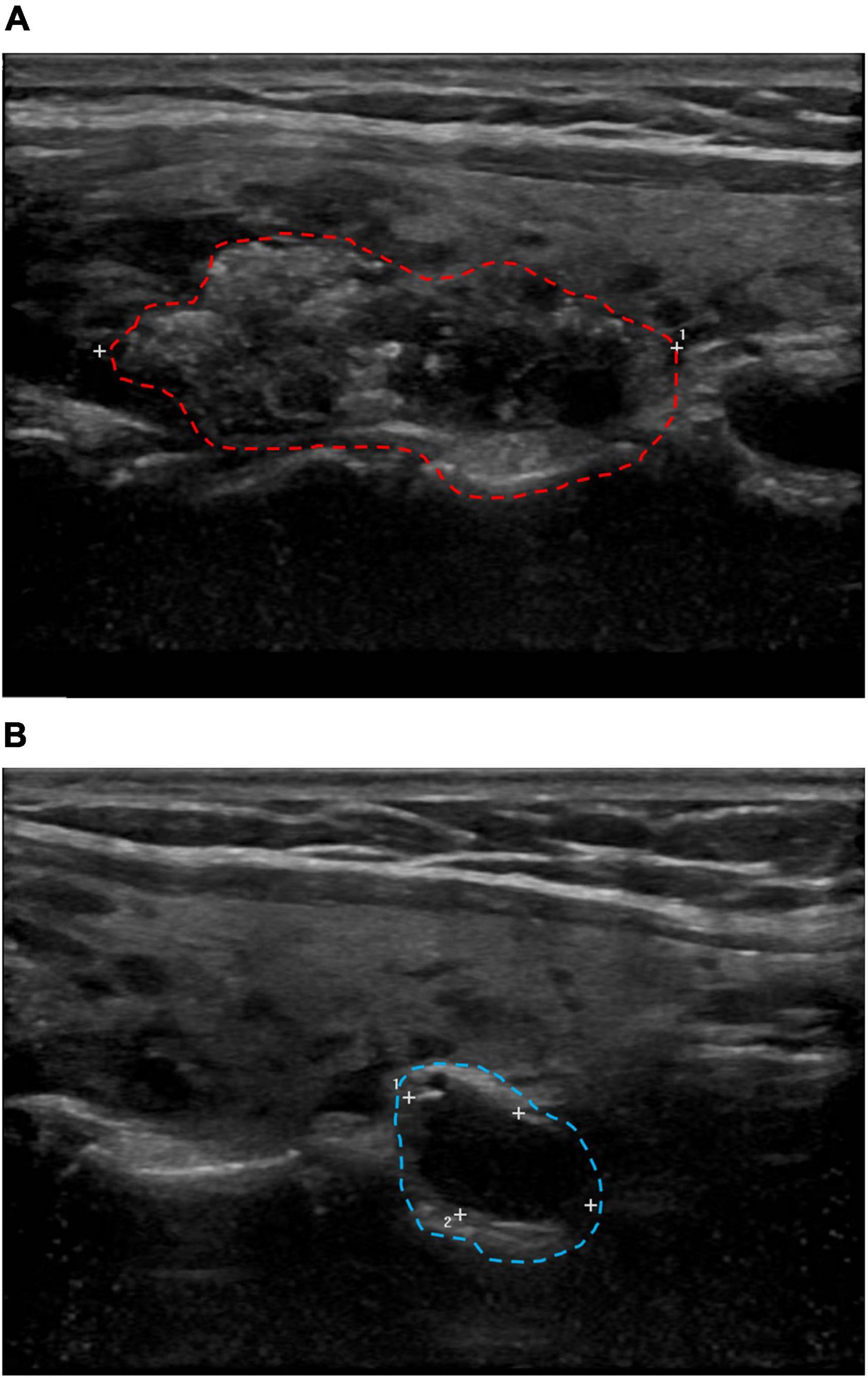 Thyroid Langerhans cell histiocytosis concurrent with papillary thyroid carcinoma: A case report and literature review